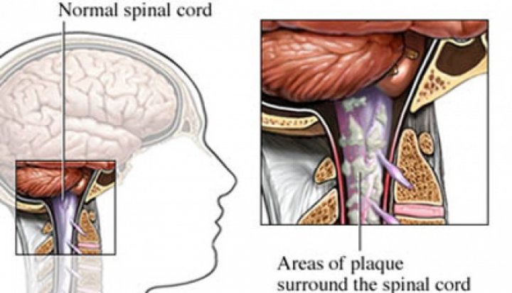 Memahami Multiple Sclerosis, Gejala dan pengobatan